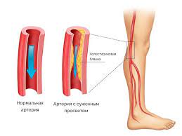 Как лечить атеросклероз ног