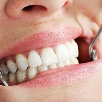 Протезирование зубов